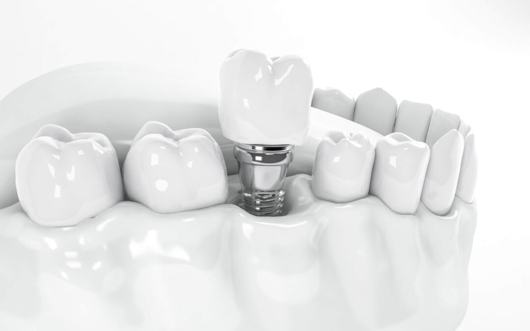 Dental Implants vs Other Options