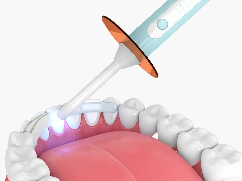 Dental bonding 3D illustration