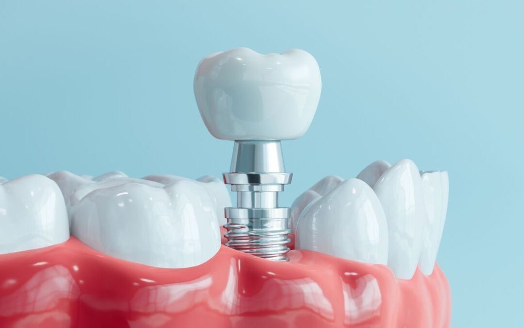Dental Implants